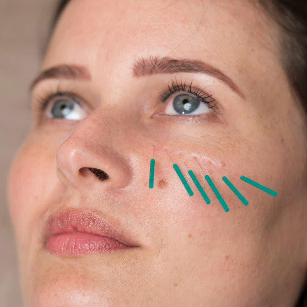 Aiguilletage à sec cosmétique / Dry needling cosmétique (cours)