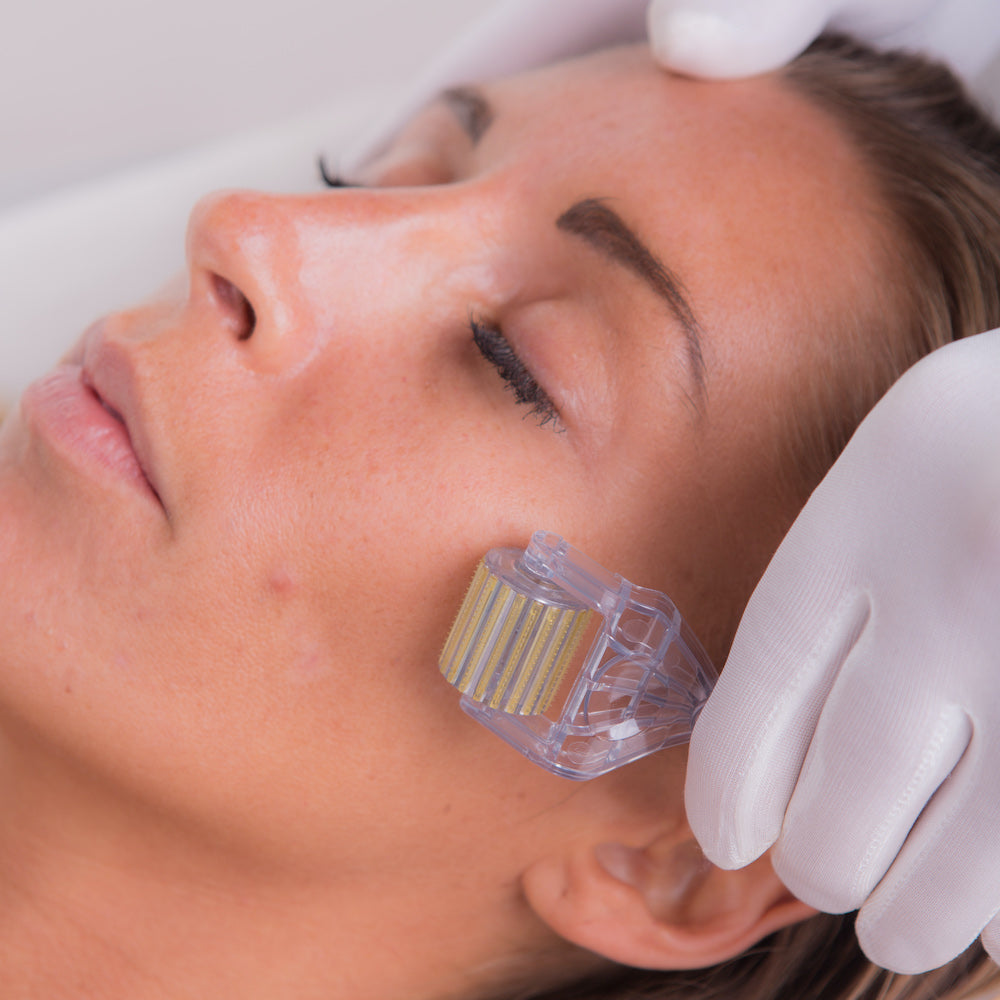 Microneedling for Acne Scars : How to Assist Acne Scars