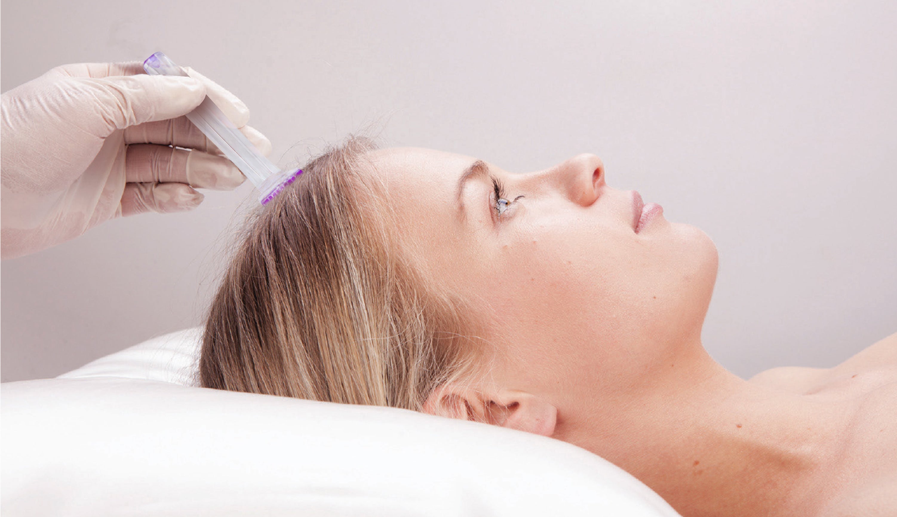 A picture of microneedling the scalp